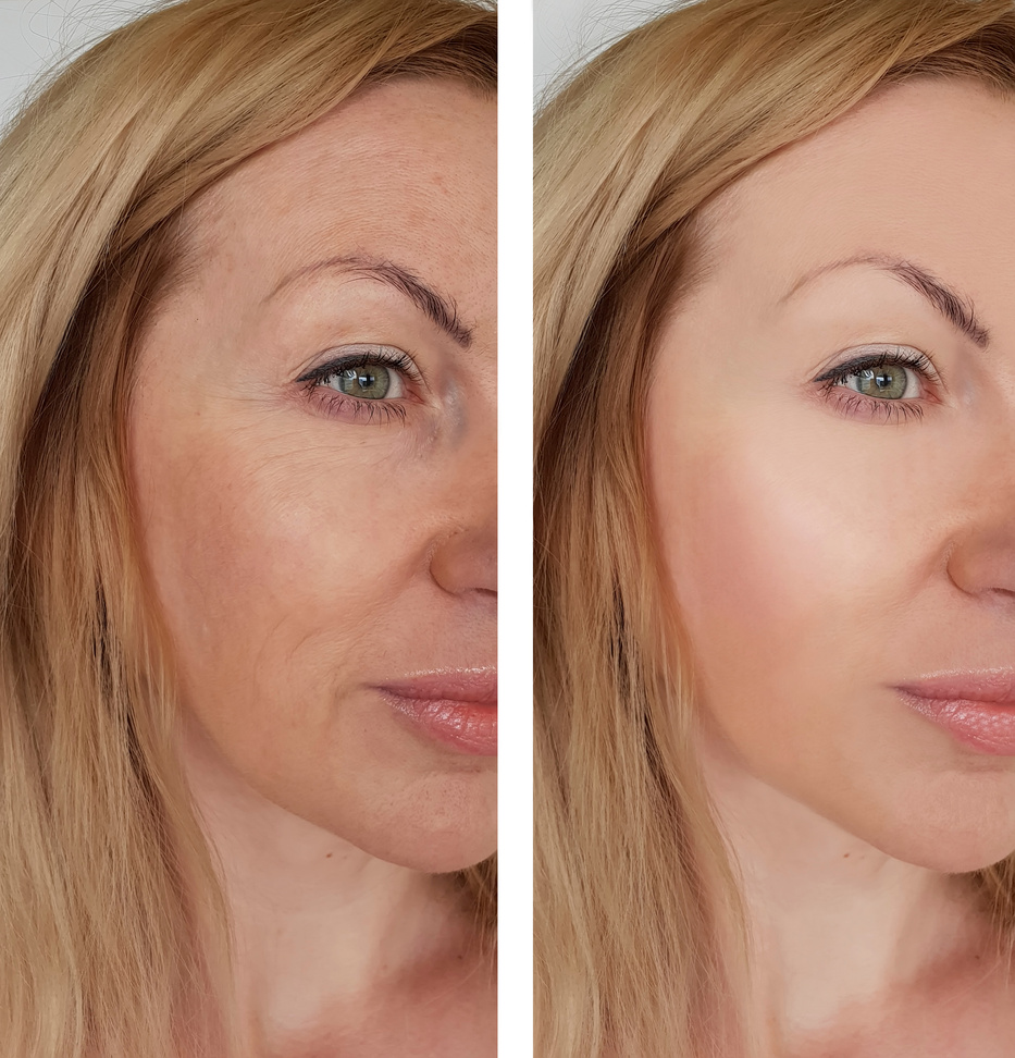 face girl wrinkles before and after cosmetic procedures